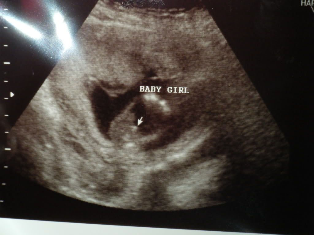 15 weeks 6 days Gender scan TECH opinions? do you agree?? in Ultrasound