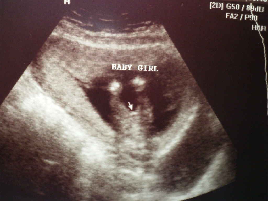 15 weeks 6 days Gender scan TECH opinions? do you agree?? in Ultrasound