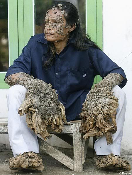dede tree man. locally as quot;The Tree Manquot;